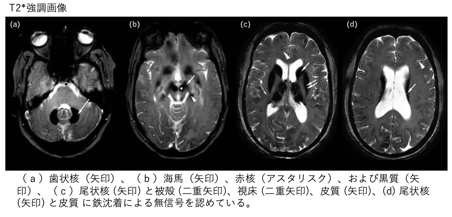無セルロプラスミン血症(ACP)のCT,MRI画像所見のポイント